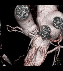 Left Anterior Descending Coronary Artery (LAD) and Circumflex Arise Directly Off the Left Cusp - CTisus CT Scan