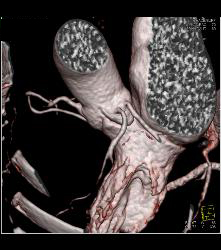 Left Anterior Descending Coronary Artery (LAD) and Circumflex Arise Directly Off the Left Cusp - CTisus CT Scan