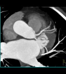 Left Anterior Descending Coronary Artery (LAD) and Circumflex Arise Directly Off the Left Cusp - CTisus CT Scan