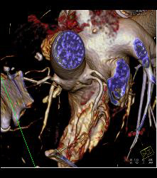 Left Anterior Descending Coronary Artery (LAD) and Circumflex Arise Directly Off the Left Cusp - CTisus CT Scan