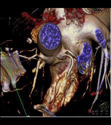 Left Anterior Descending Coronary Artery (LAD) and Circumflex Arise Directly Off the Left Cusp - CTisus CT Scan