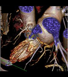 Left Anterior Descending Coronary Artery (LAD) and Circumflex Arise Directly Off the Left Cusp - CTisus CT Scan