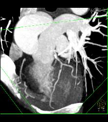 Left Anterior Descending Coronary Artery (LAD) Disease - CTisus CT Scan