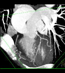 Left Anterior Descending Coronary Artery (LAD) Disease - CTisus CT Scan