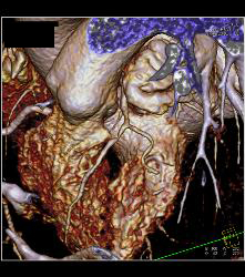 Left Anterior Descending Coronary Artery (LAD) Disease - CTisus CT Scan