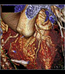 Left Anterior Descending Coronary Artery (LAD) Disease - CTisus CT Scan