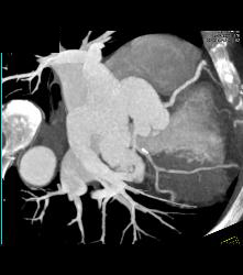 Left Anterior Descending Coronary Artery (LAD) Disease - CTisus CT Scan