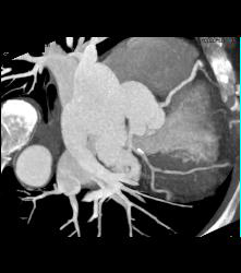 Left Anterior Descending Coronary Artery (LAD) Disease - CTisus CT Scan