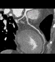 Left Anterior Descending Coronary Artery (LAD) Disease - CTisus CT Scan