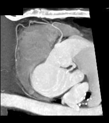 Minimal RCA Disease - CTisus CT Scan