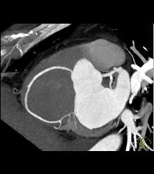 Minimal RCA Disease - CTisus CT Scan