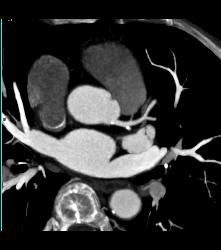 Minimal Left Anterior Descending Coronary Artery (LAD) Disease - CTisus CT Scan