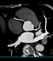 Minimal Left Anterior Descending Coronary Artery (LAD) Disease - CTisus CT Scan