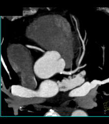 Minimal Left Anterior Descending Coronary Artery (LAD) Disease - CTisus CT Scan