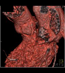 Minimal Left Anterior Descending Coronary Artery (LAD) Disease - CTisus CT Scan