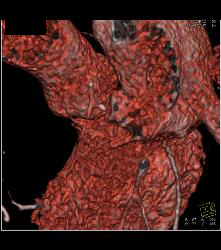 Minimal Left Anterior Descending Coronary Artery (LAD) Disease - CTisus CT Scan