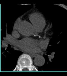 Minimal Left Anterior Descending Coronary Artery (LAD) Disease - CTisus CT Scan