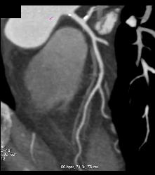 Minimal Left Anterior Descending Coronary Artery (LAD) Disease - CTisus CT Scan