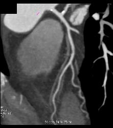 Minimal Left Anterior Descending Coronary Artery (LAD) Disease - CTisus CT Scan