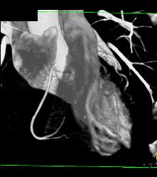 Minimal Left Anterior Descending Coronary Artery (LAD) Disease - CTisus CT Scan