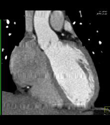 Computer Error With ??? Down and Drop in Heart Rate - CTisus CT Scan