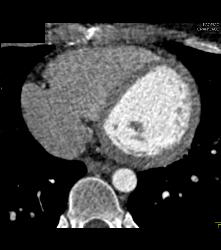 Computer Error With ??? Down and Drop in Heart Rate - CTisus CT Scan