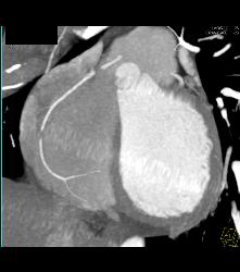 Pseudo-lesion in RCA - CTisus CT Scan