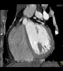 Trifurcation - CTisus CT Scan