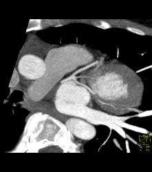 Trifurcation - CTisus CT Scan