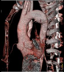 Dilated Root With Marfan - CTisus CT Scan