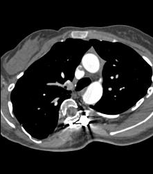 Dilated Arch and Root - CTisus CT Scan