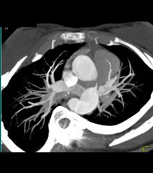 Dilated Arch and Root - CTisus CT Scan