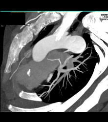 Dilated Arch and Root - CTisus CT Scan