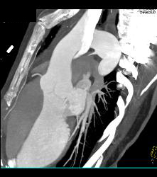 Dilated Arch and Root - CTisus CT Scan