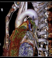 Dilated Arch - CTisus CT Scan