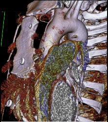 Dilated Arch - CTisus CT Scan