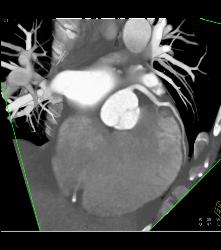 Dilated Arch - CTisus CT Scan