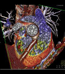 Normal RCA and CTA - CTisus CT Scan