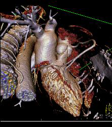 Normal RCA and CTA - CTisus CT Scan