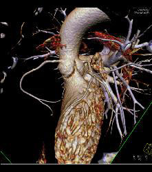 Normal RCA and CTA - CTisus CT Scan