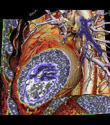 Normal RCA and CTA - CTisus CT Scan