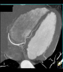 Normal RCA and CTA - CTisus CT Scan