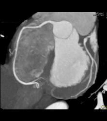 Normal RCA and CTA - CTisus CT Scan