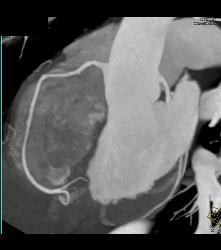 Normal RCA and CTA - CTisus CT Scan