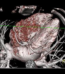 Normal RCA and CTA - CTisus CT Scan