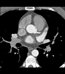 Normal RCA and CTA - CTisus CT Scan