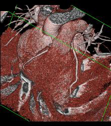 Normal RCA and CTA - CTisus CT Scan