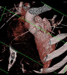 Normal RCA and CTA - CTisus CT Scan