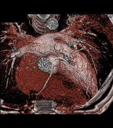 Normal RCA - CTisus CT Scan