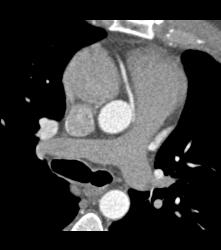 Normal RCA - CTisus CT Scan